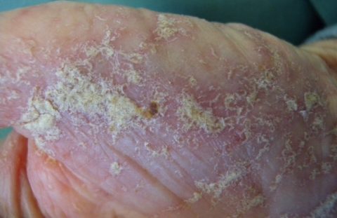 Scabies - Agricultural Biology